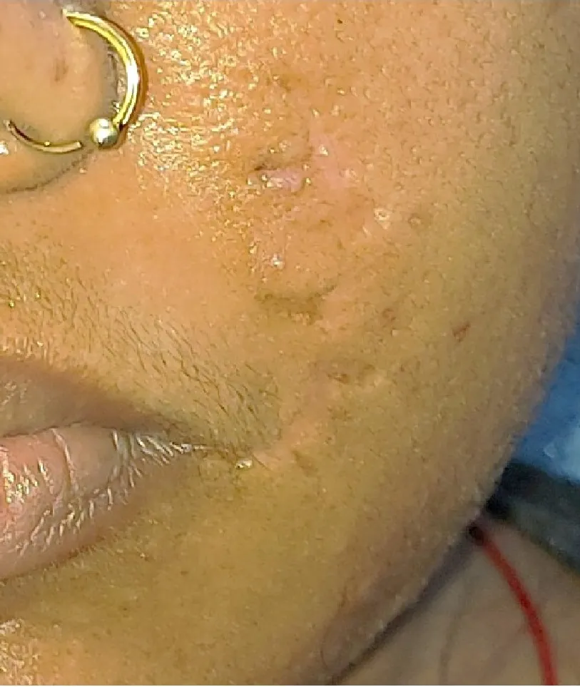Scar Revision — after