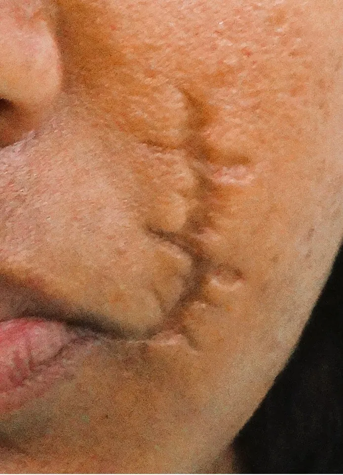 Scar Revision — before