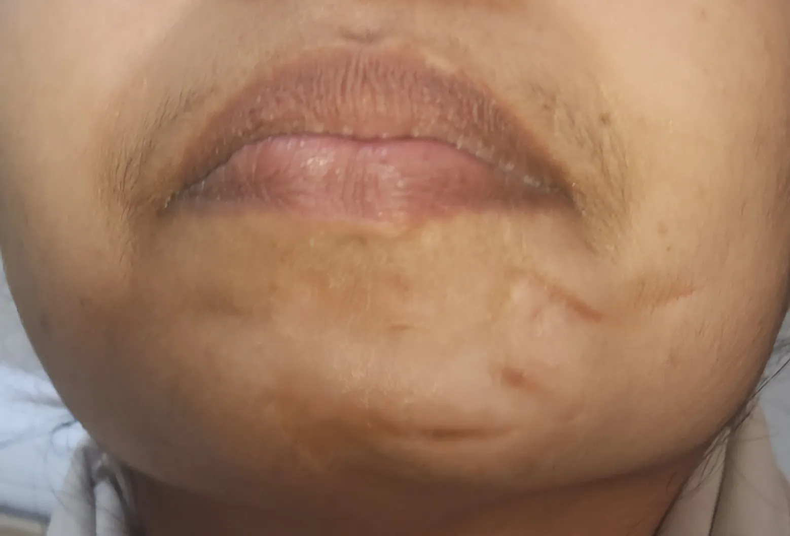 Scar Revision — after