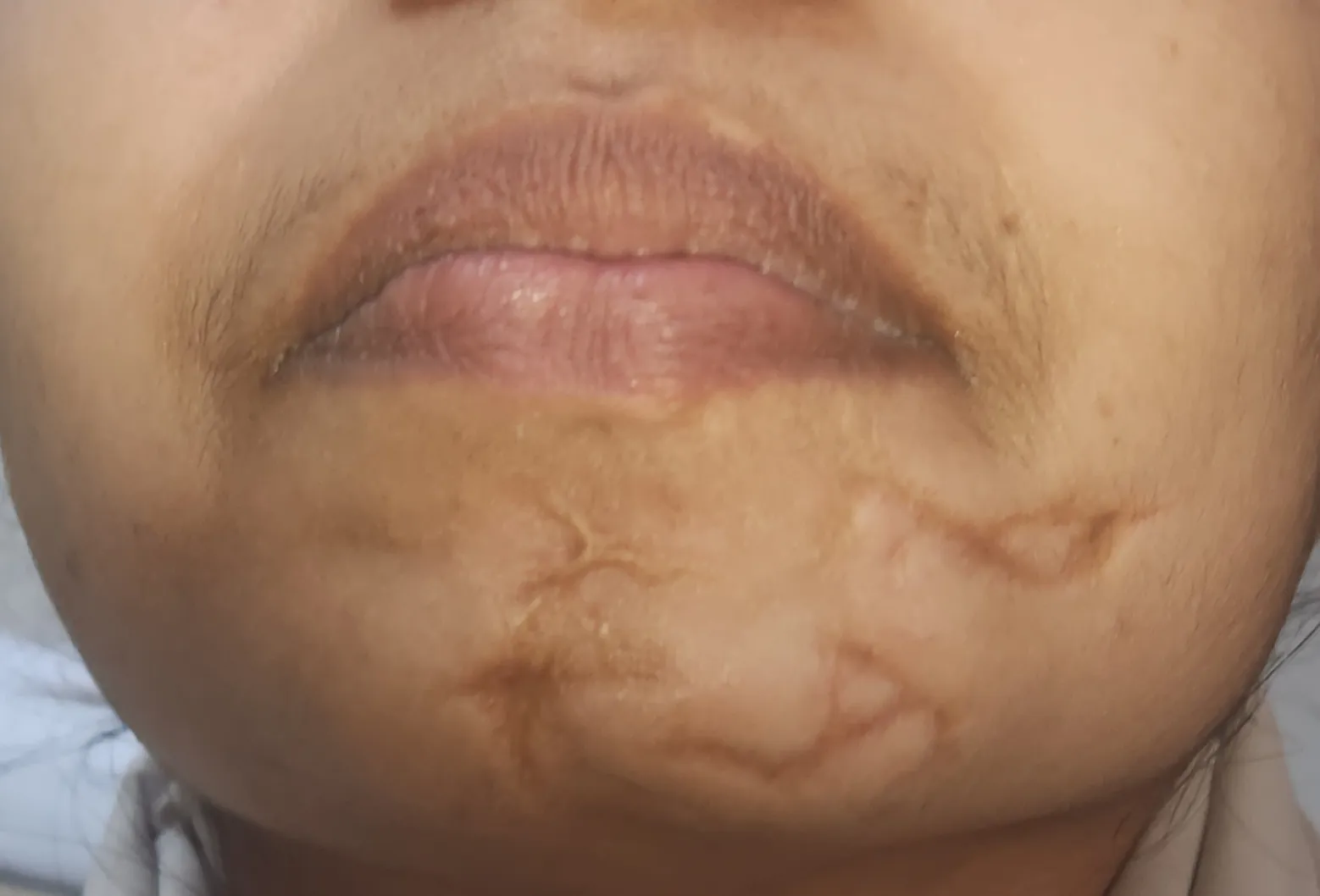 Scar Revision — before