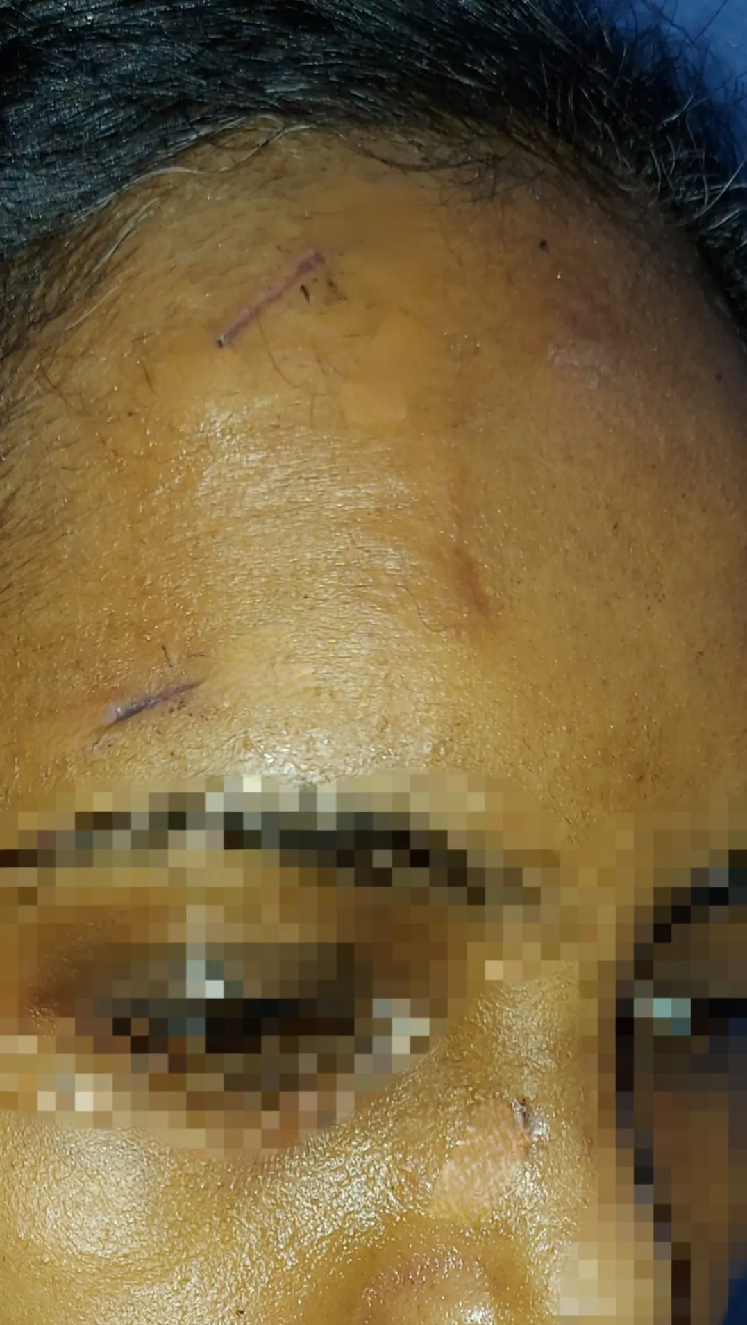 Scar Revision — after