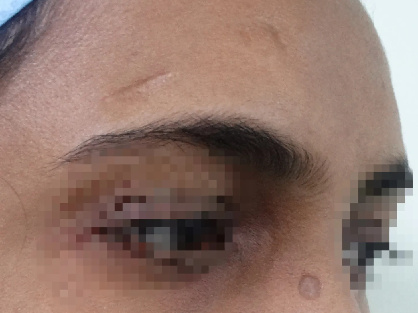 Scar Revision — before