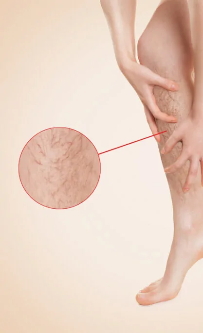 Varicose Veins