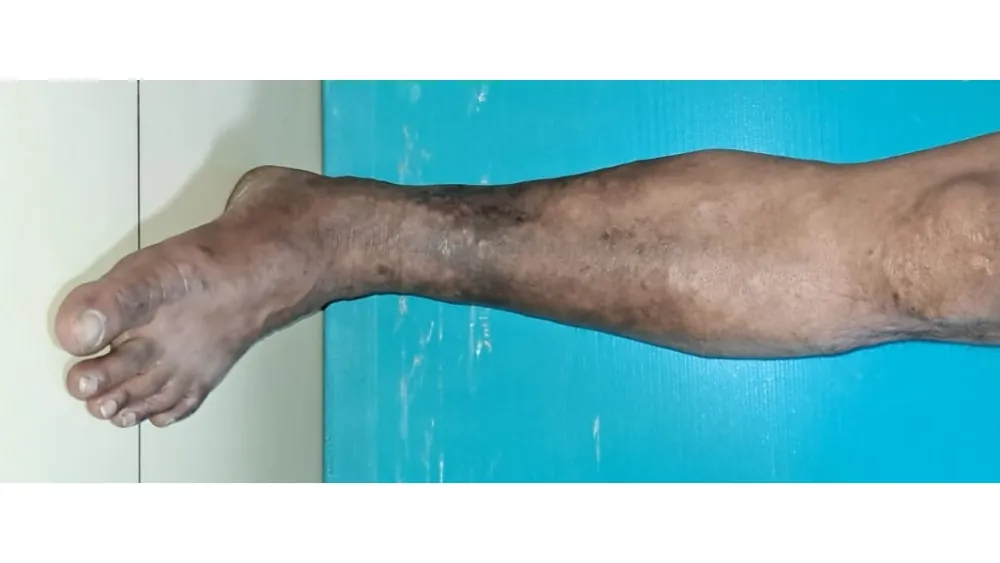 Varicose Veins — before