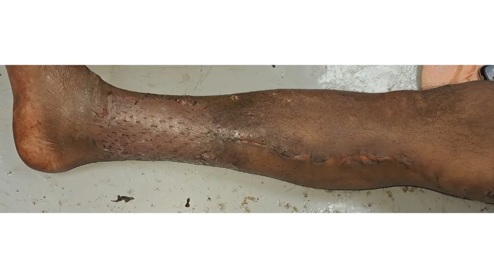 Varicose Veins — after