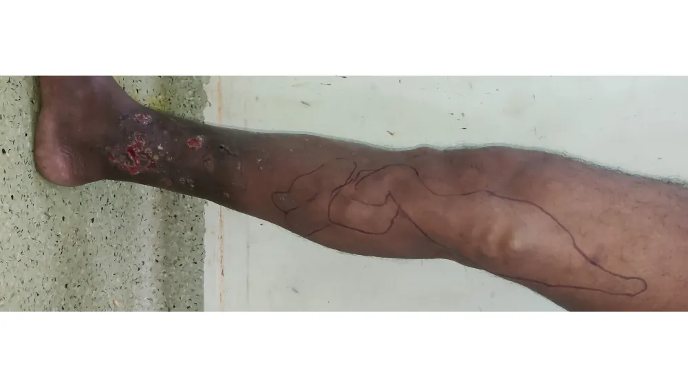 Varicose Veins — before