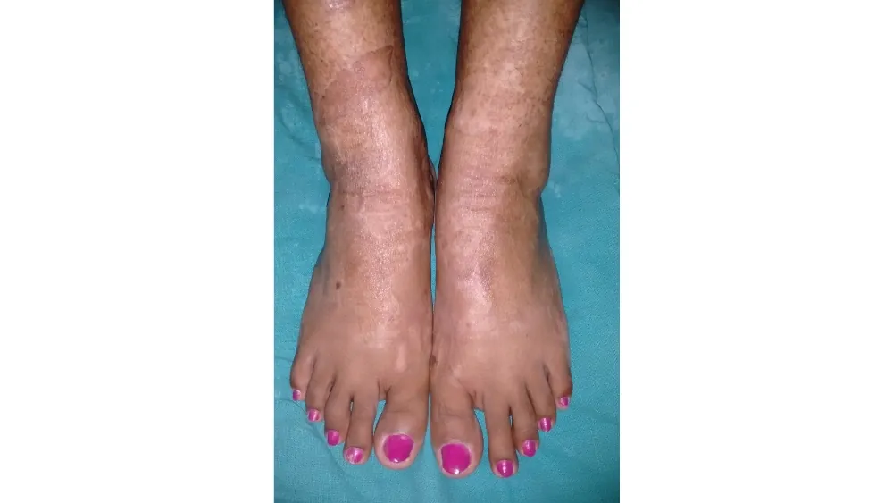 Vitiligo — after