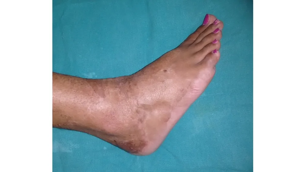 Vitiligo — after