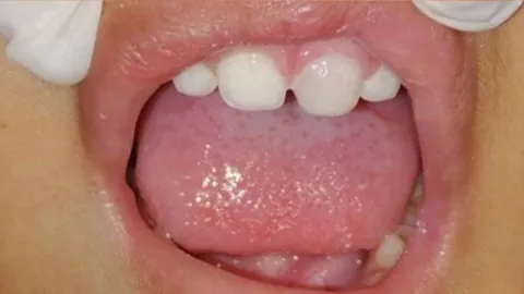Childrens Dentistry — after