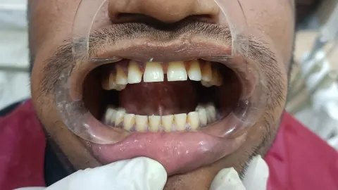 Cosmetic Dentistry — before