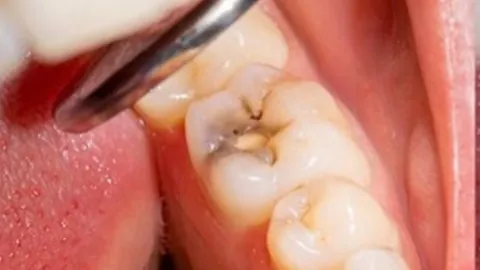 Dental Fillings — before