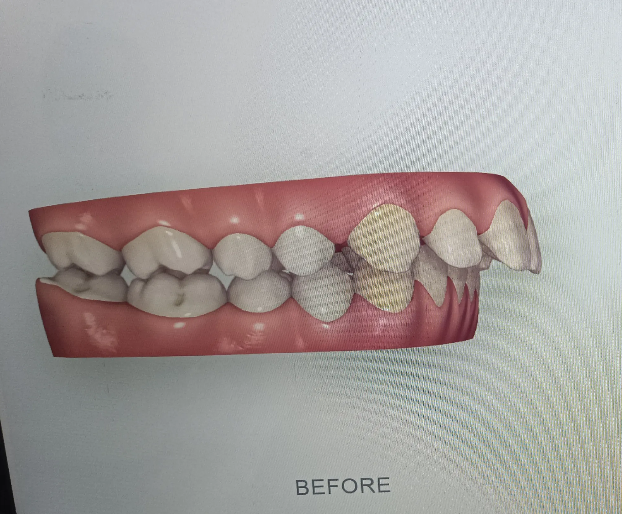 Smile Designing — before