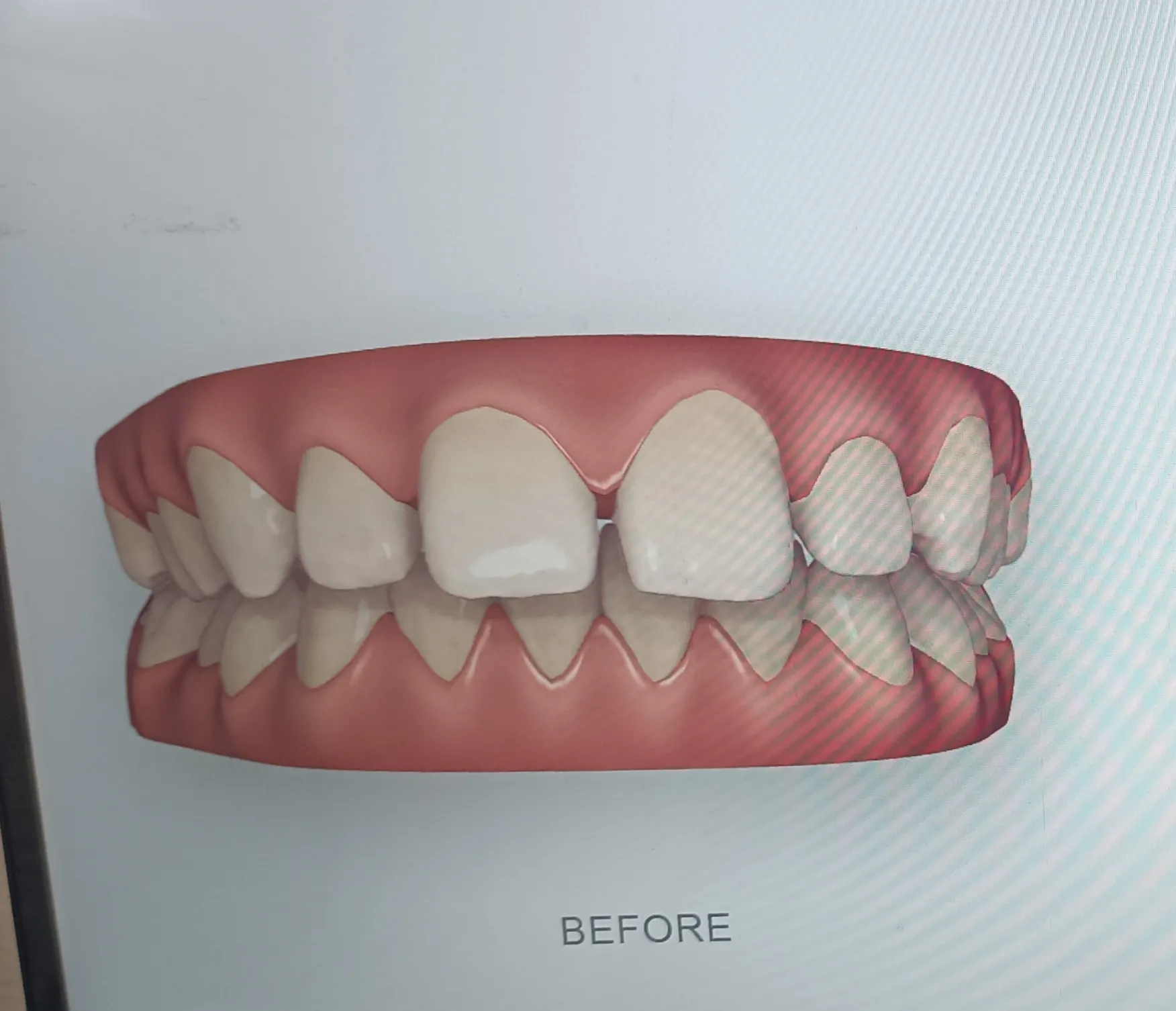 Smile Designing — before