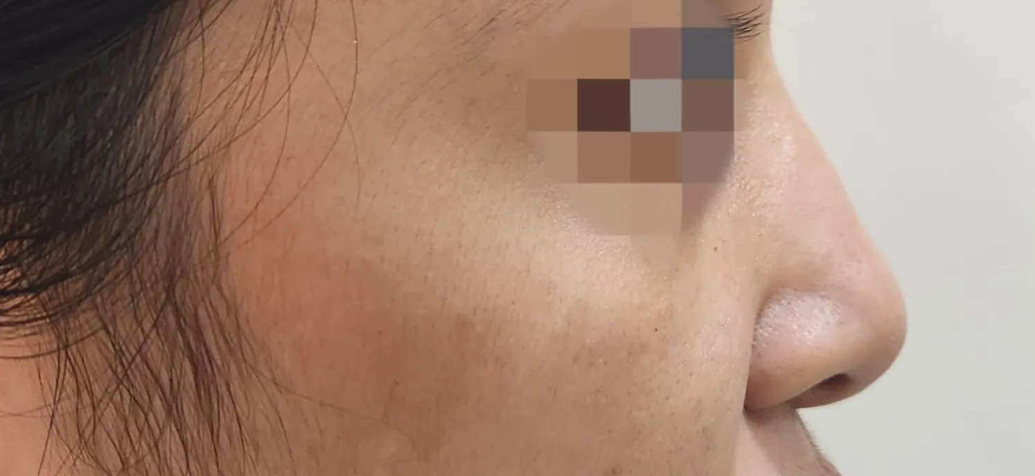 Dermal Fillers — after
