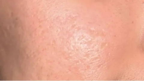 Laser Treatments — after