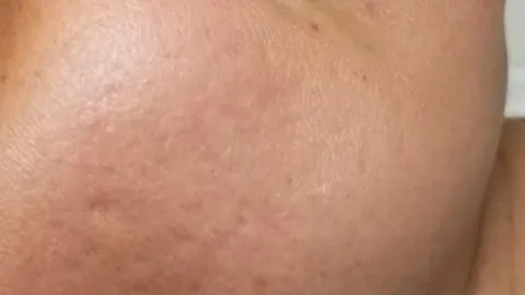 Laser Treatments — after