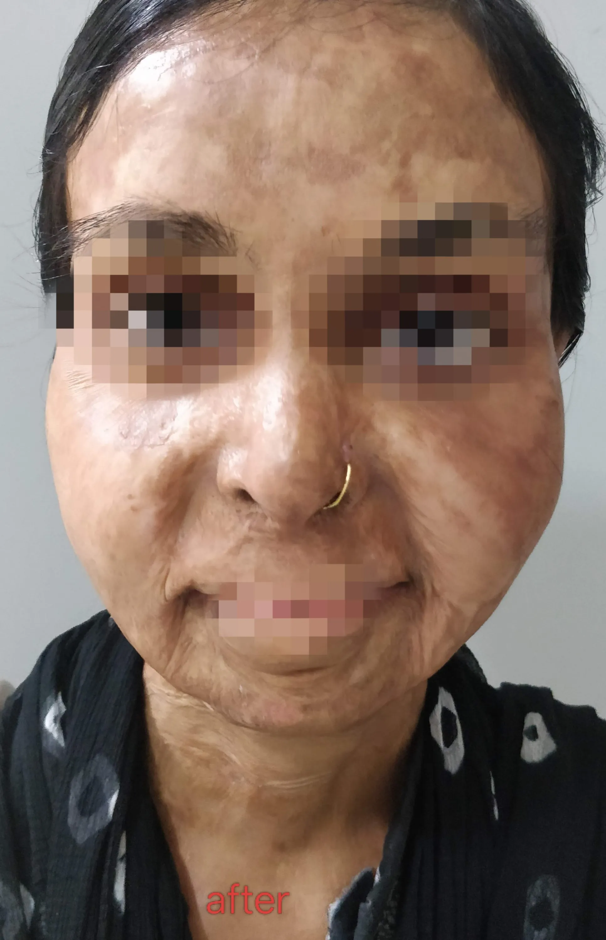 Skin Lightening — after