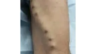 AV Fistula Complications — after