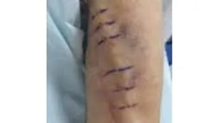 AV Fistula Complications — before