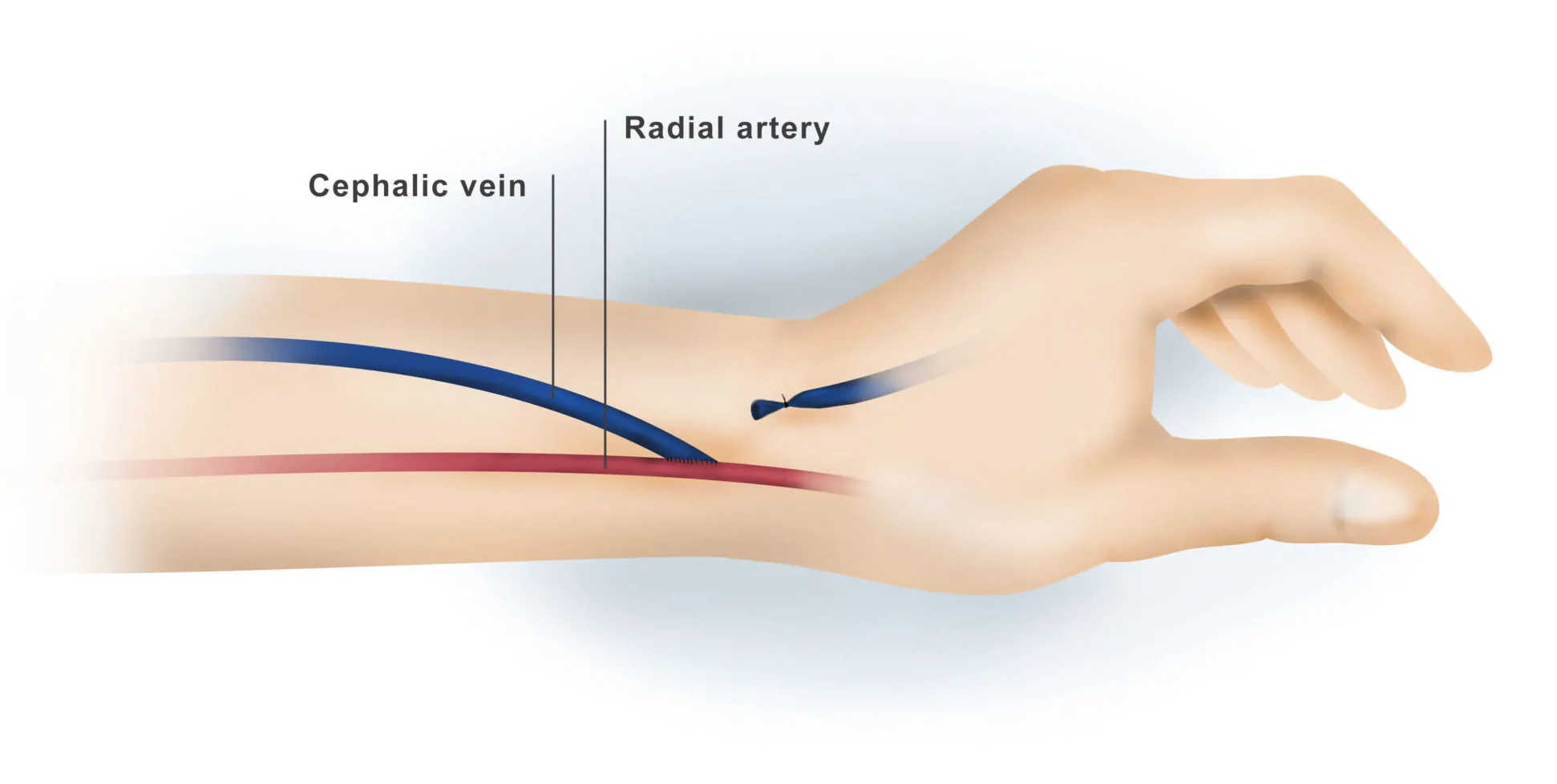 AV Fistula for Dialysis — hero image