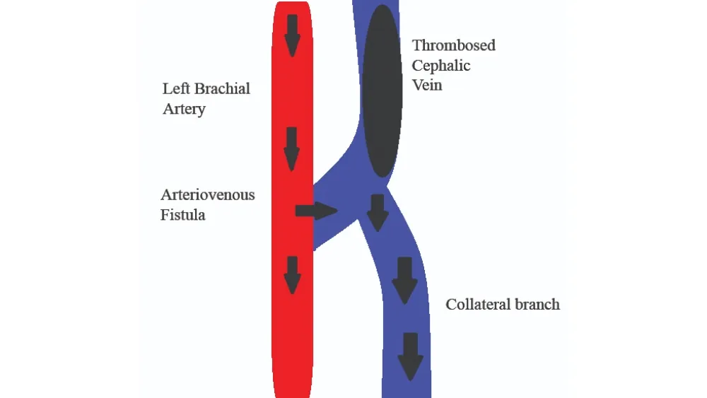Understanding AV Fistula