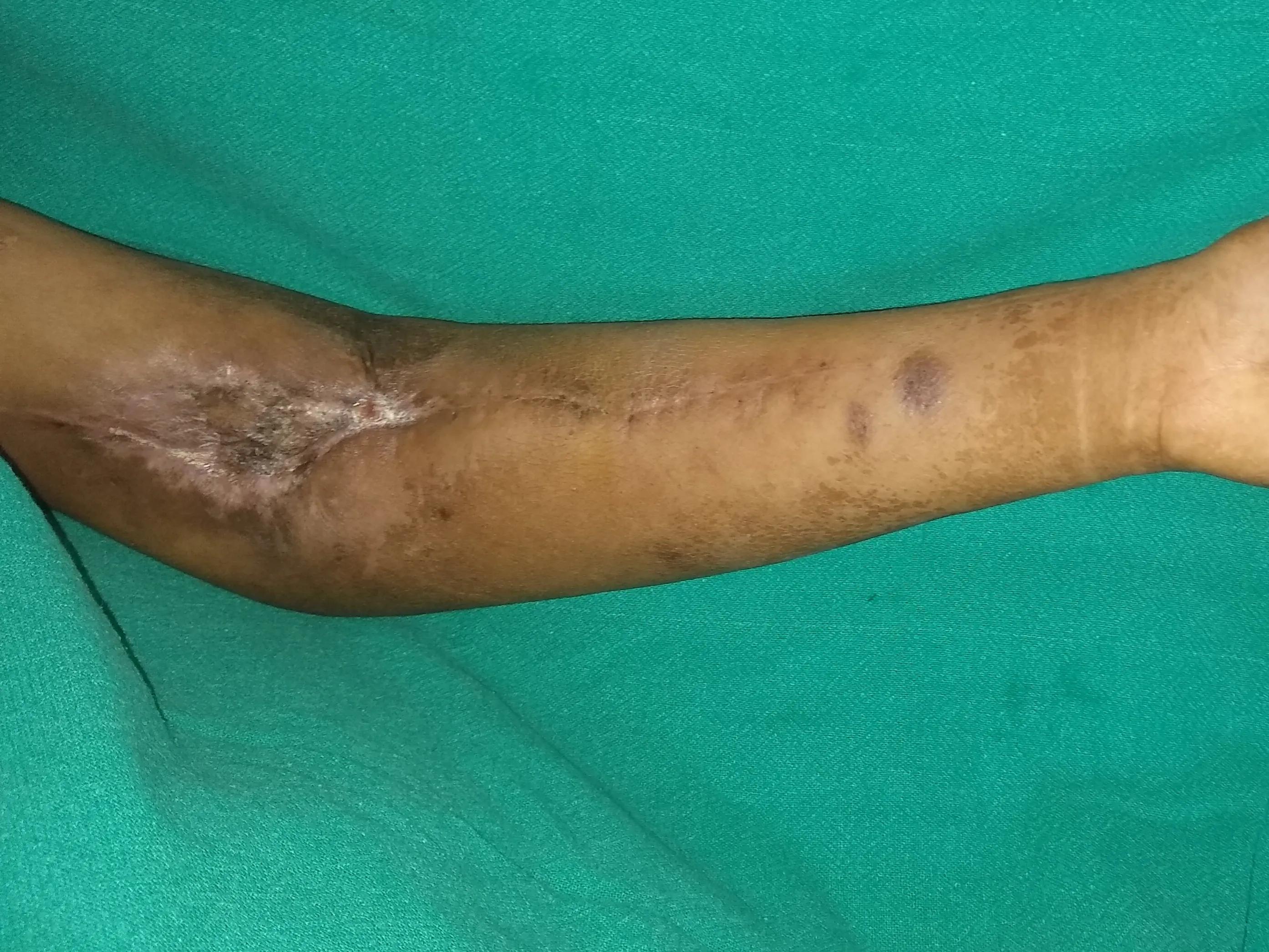 Pseudoaneurysms — after