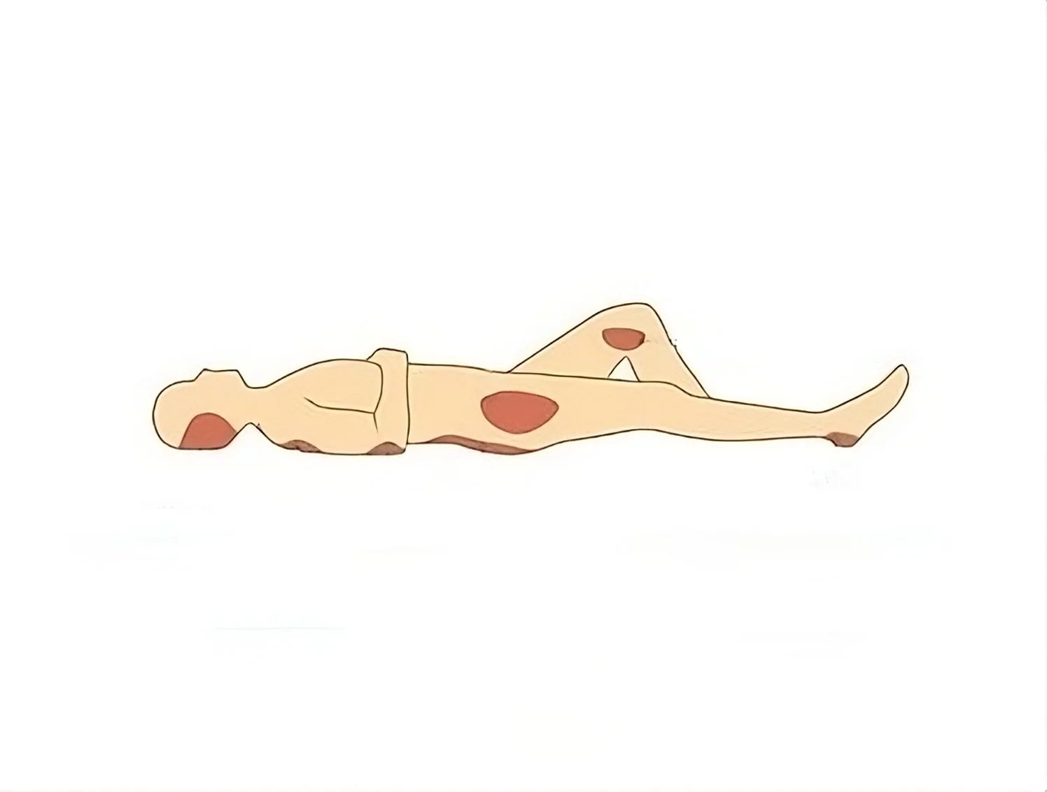 Bed Sores in Unusual Places (Heel, Scalp, Upper Back, Knee) — hero image