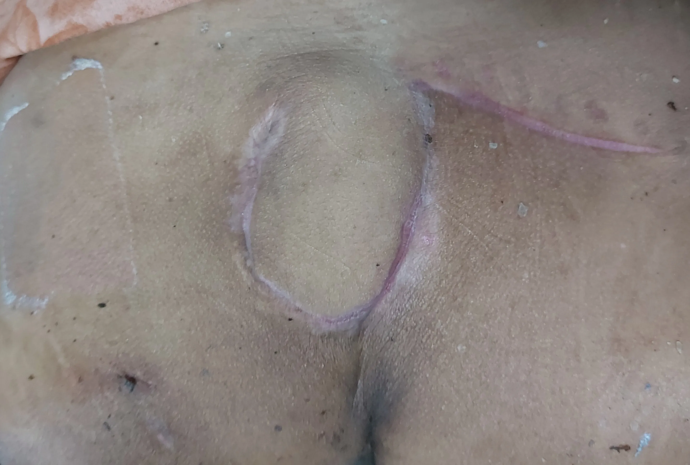 Bedsore Sacrum — after