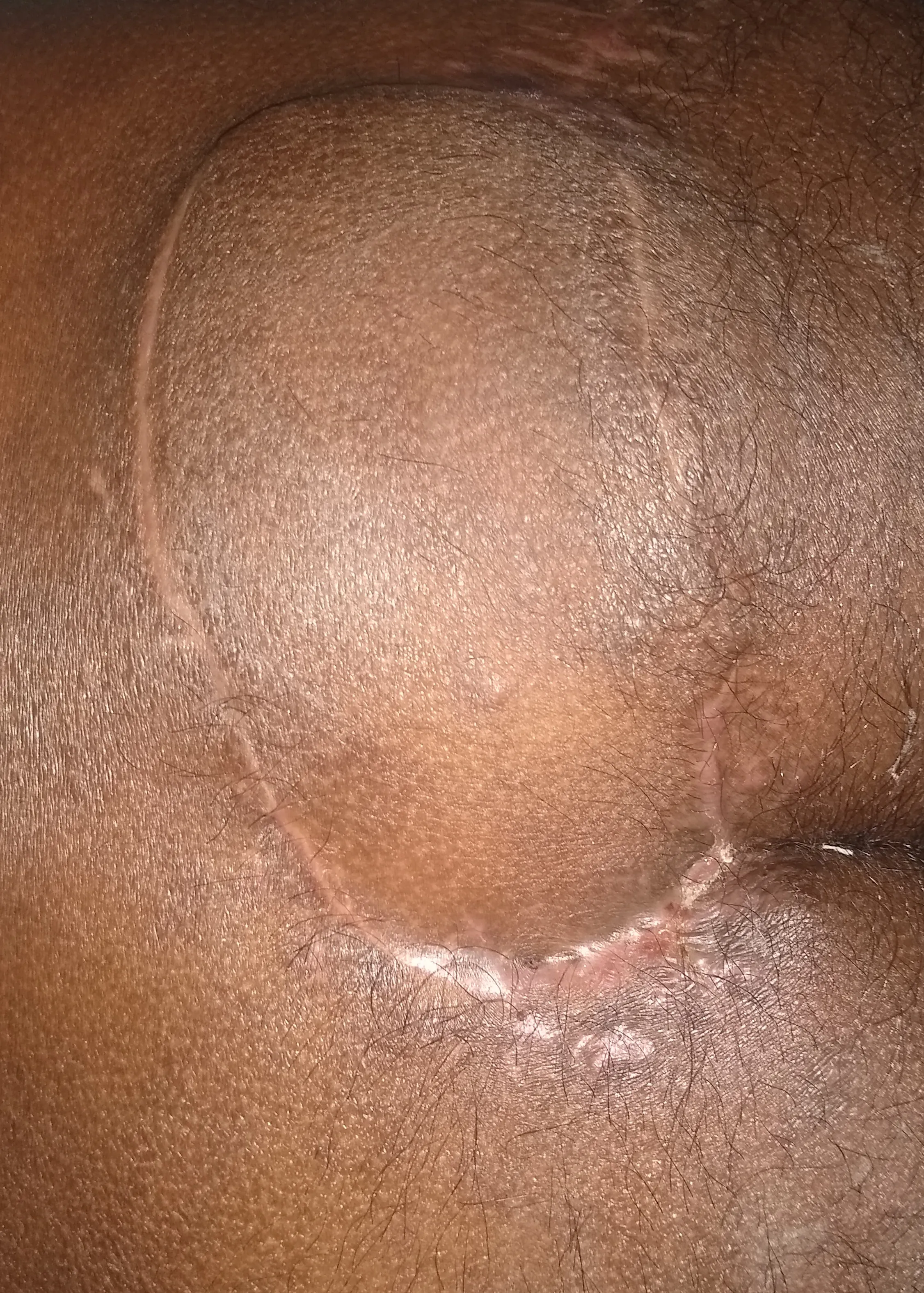Bedsore Sacrum — after