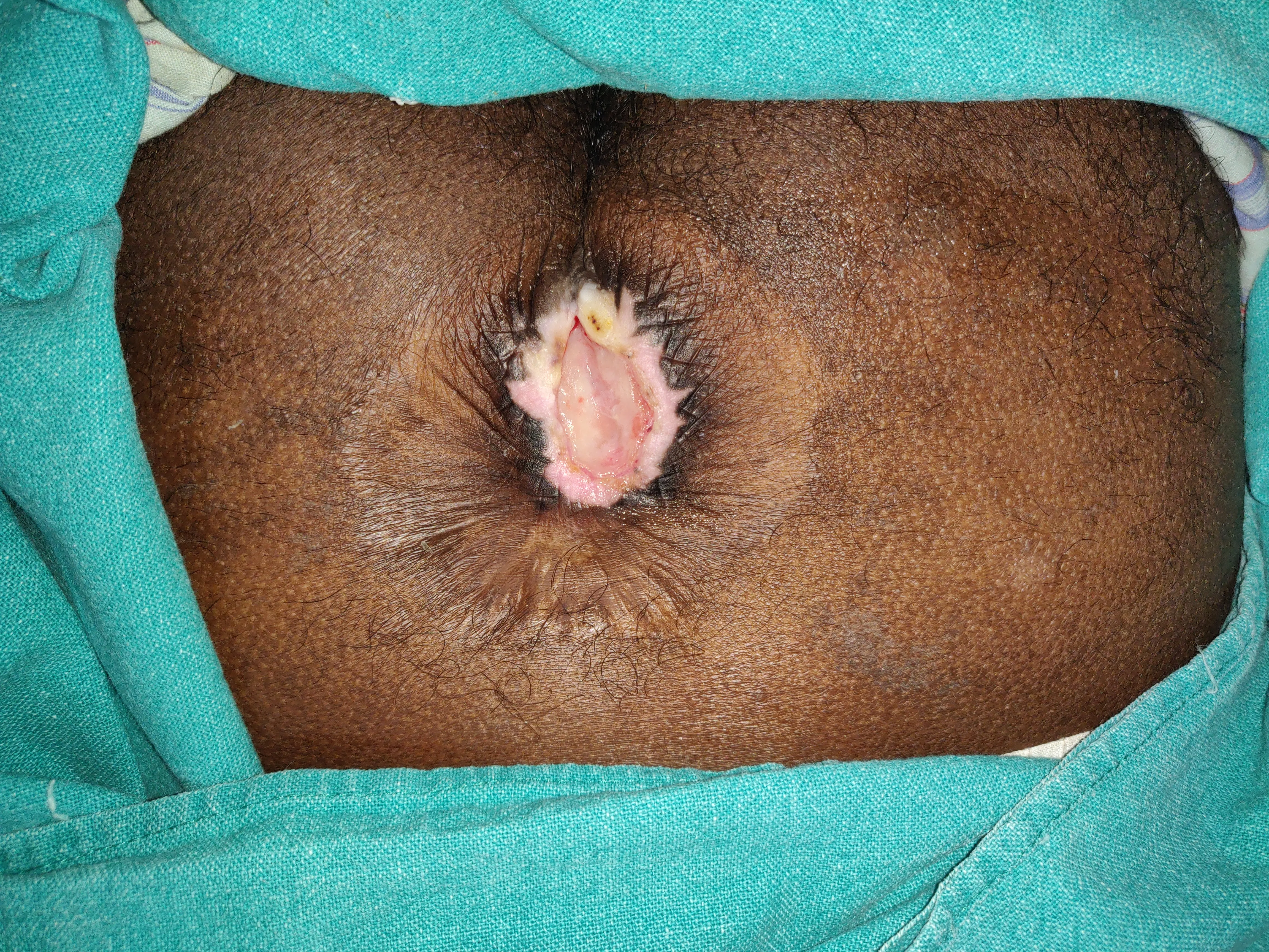 Bedsore Sacrum — before