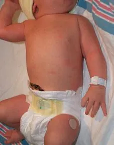 Brachial Plexus Injuries In Children — after