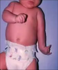 Brachial Plexus Injuries In Children — before