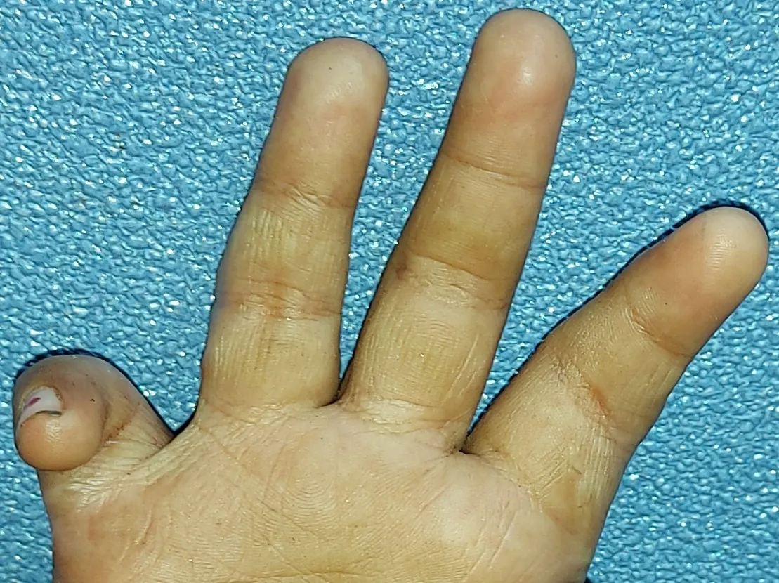 Burn Contractures — after