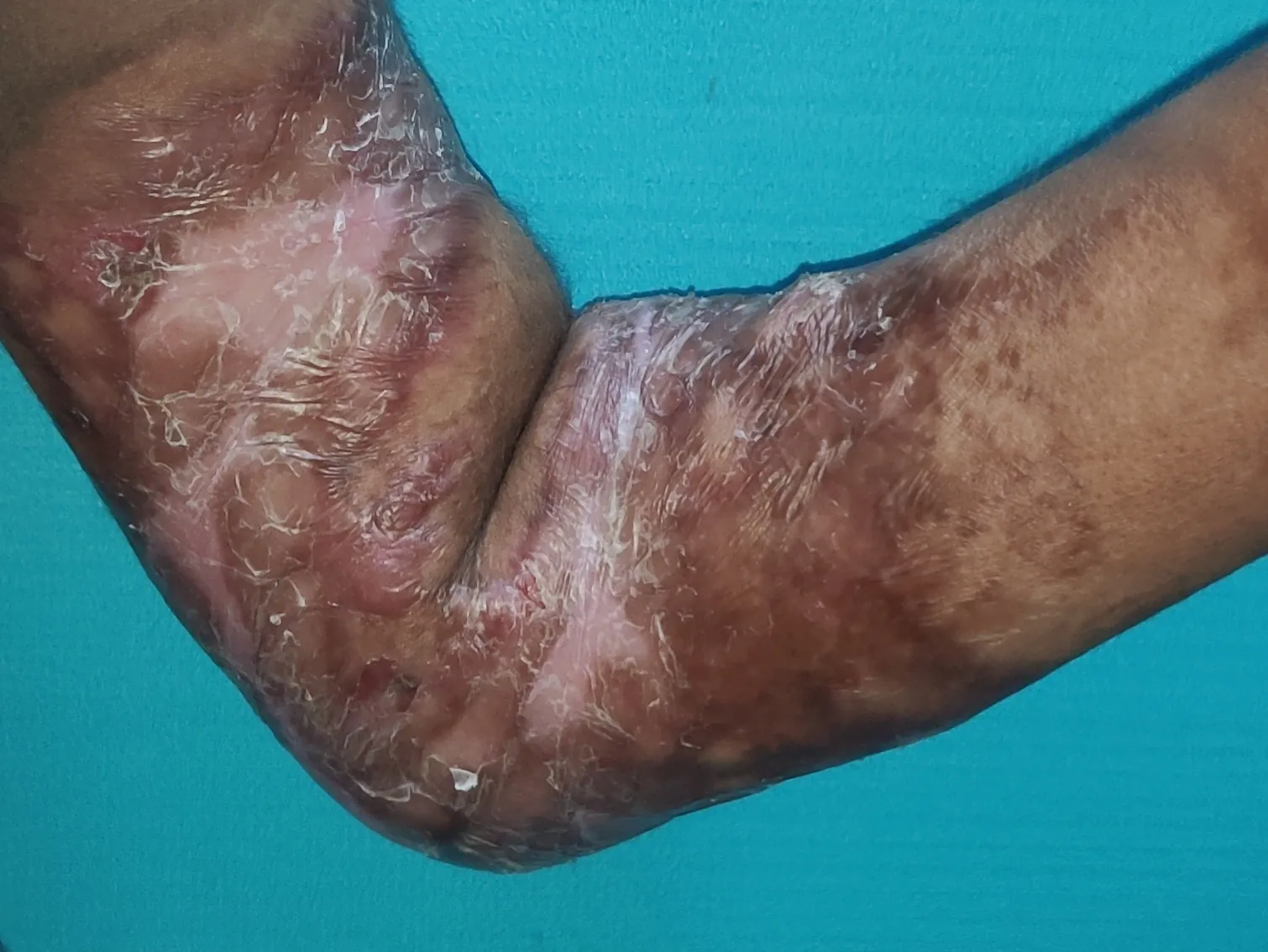Burn Contractures — before