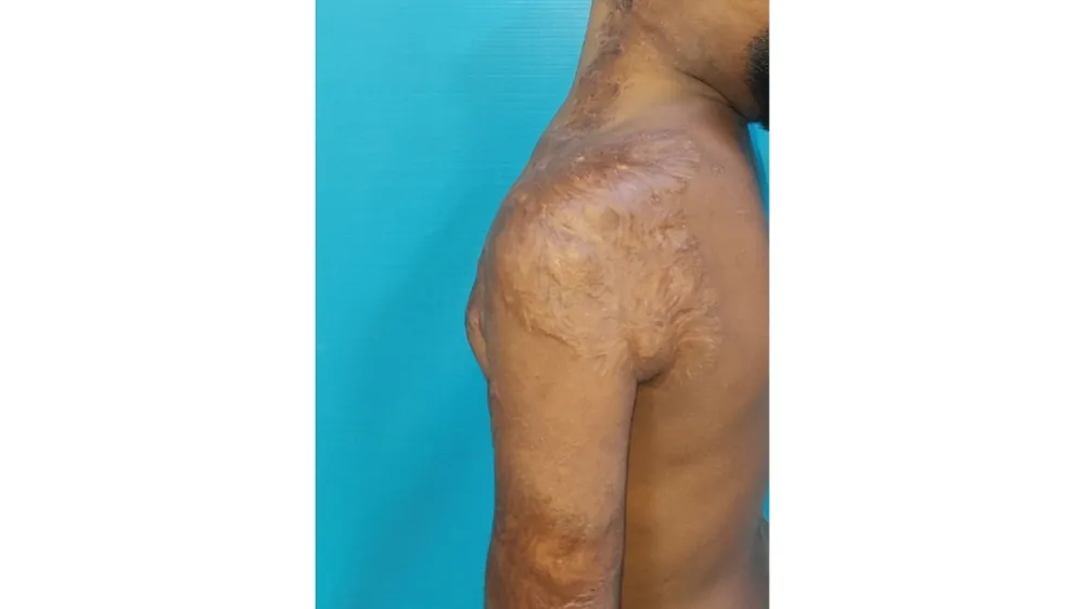 Burn Contractures — after