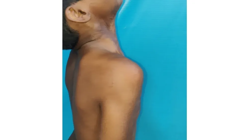 Burn Contractures — after