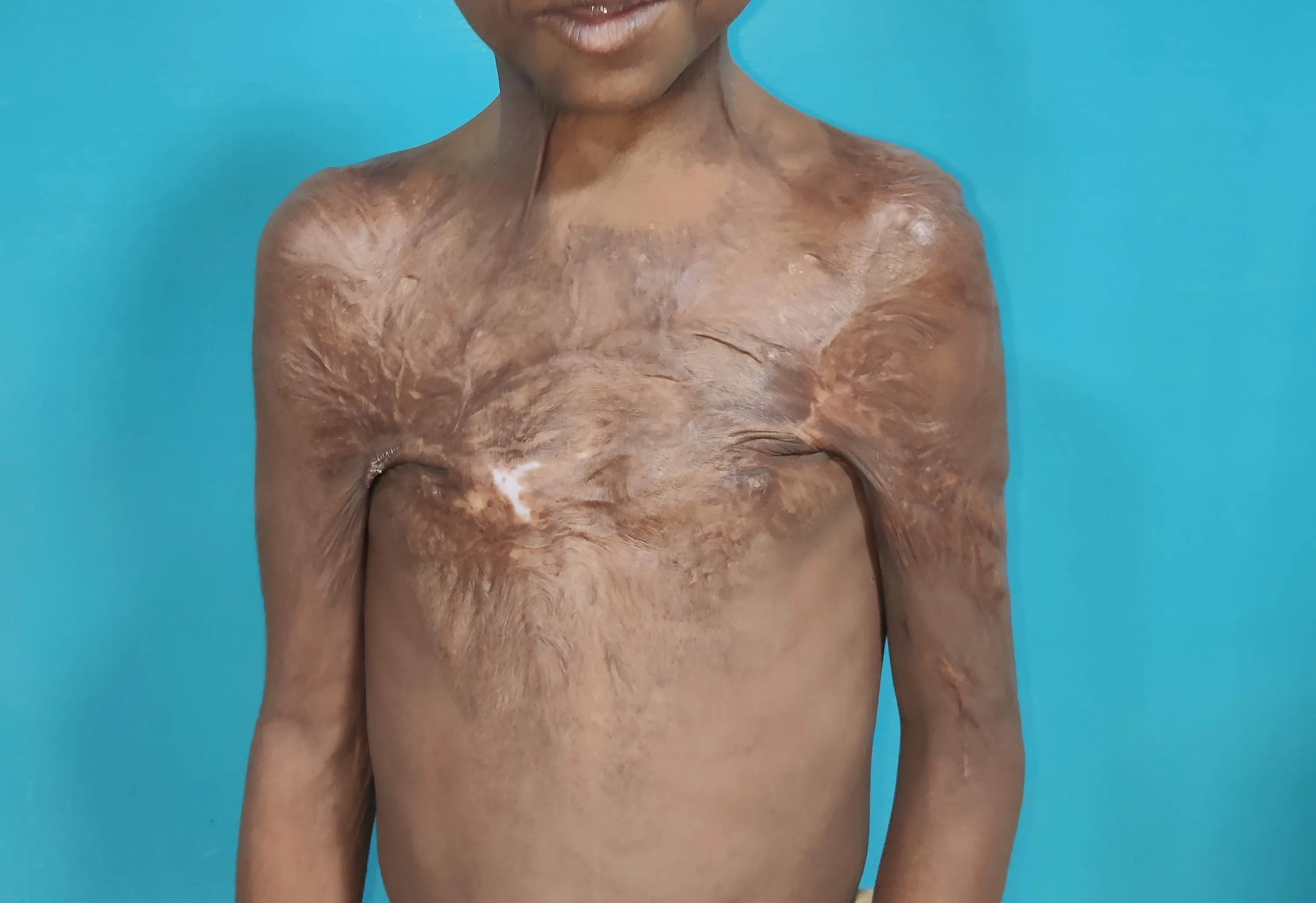 Burn Contractures — before
