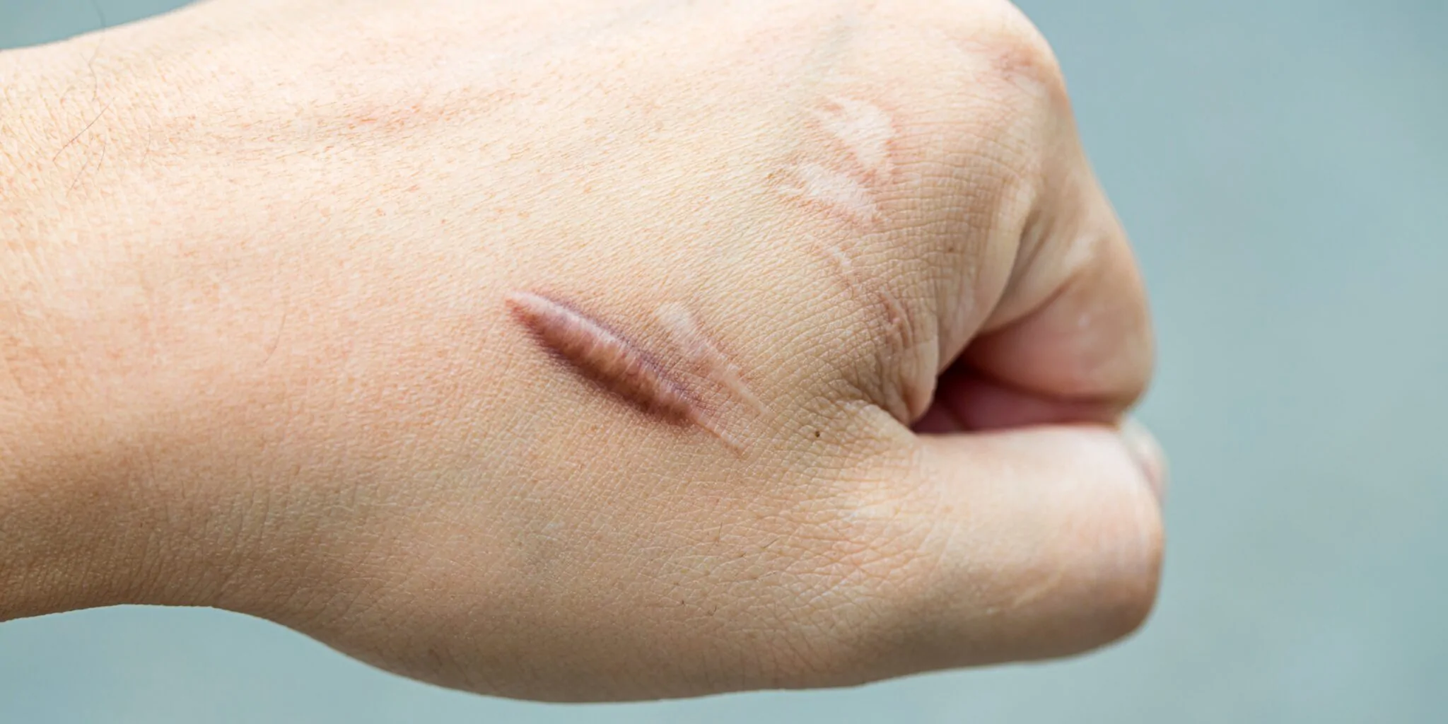 Burn White Patch/ Keloid Scar — hero image