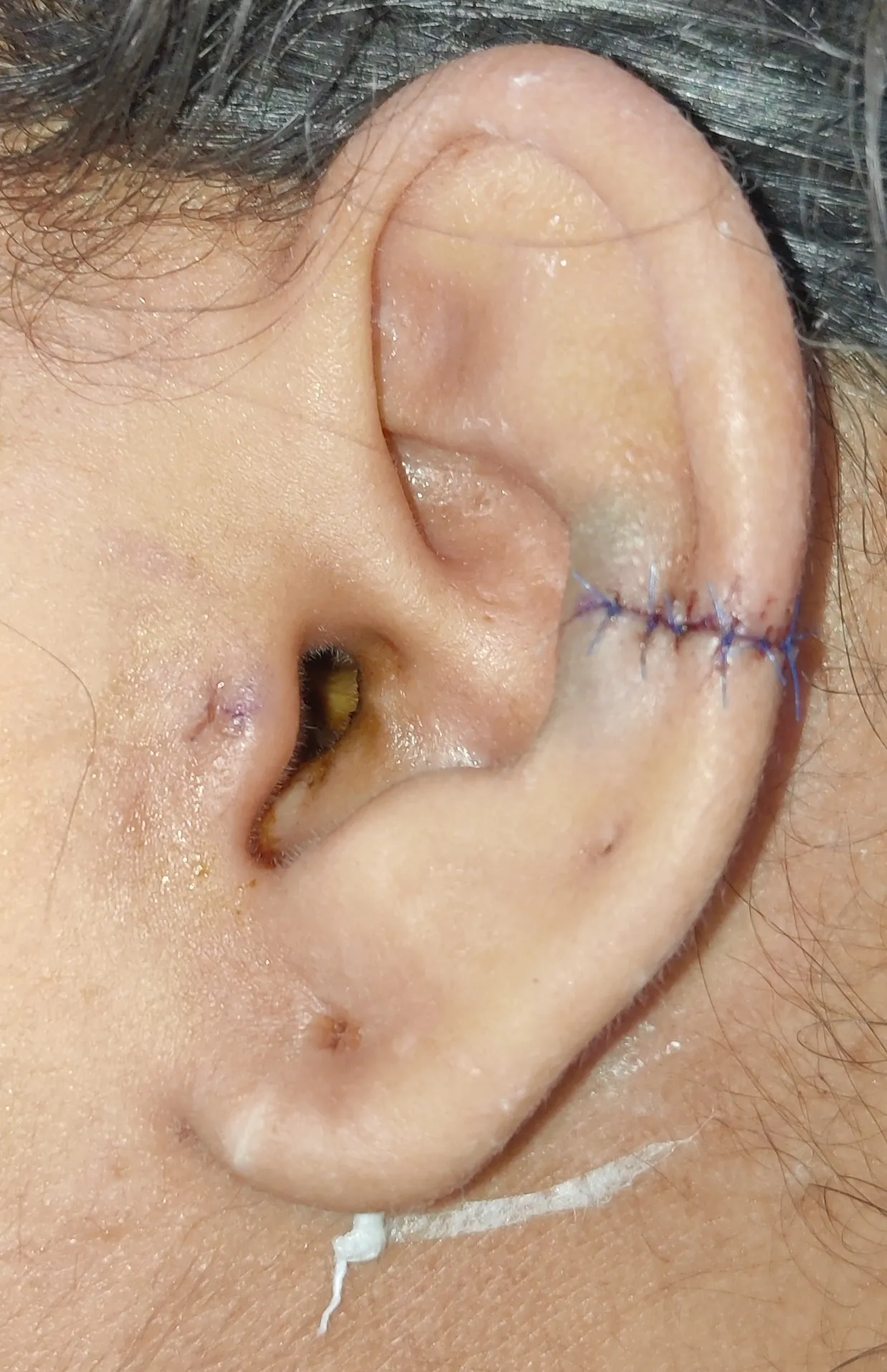Burn Keloid Scar — after