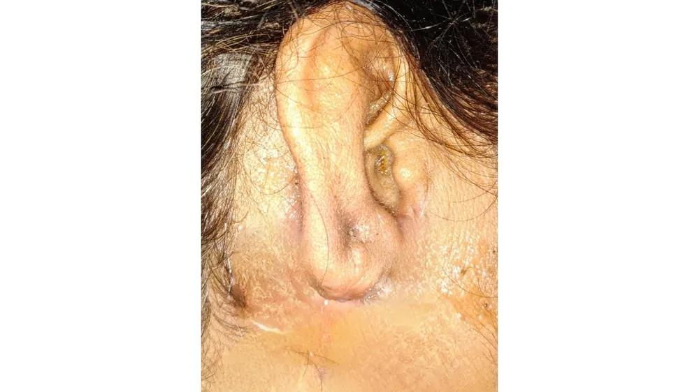 Burn Keloid Scar — after