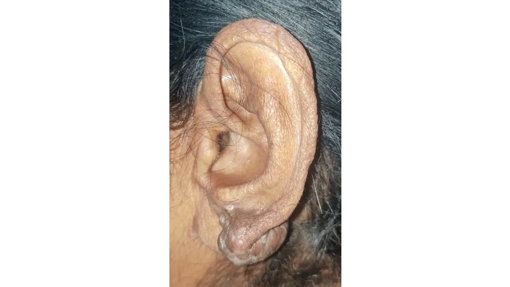 Burn Keloid Scar — before