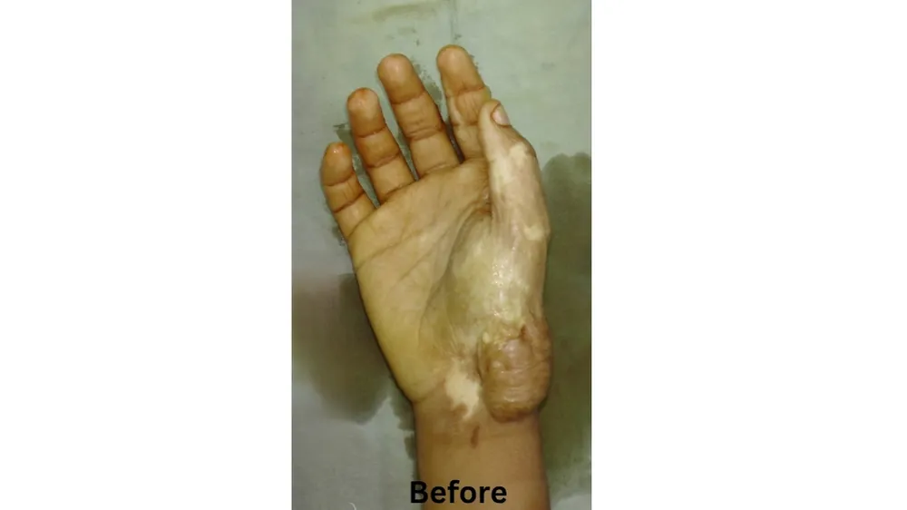 Burn Keloid Scar — before