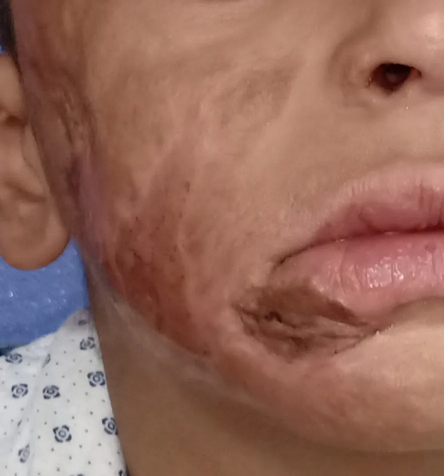 Burn Keloid Scar — after