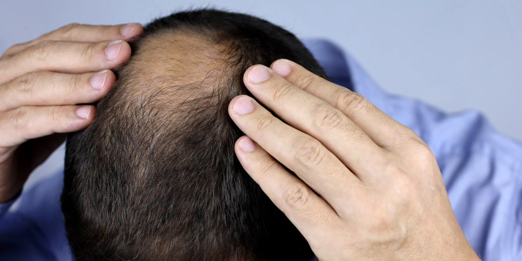 Burn Scar Hair Loss — hero image