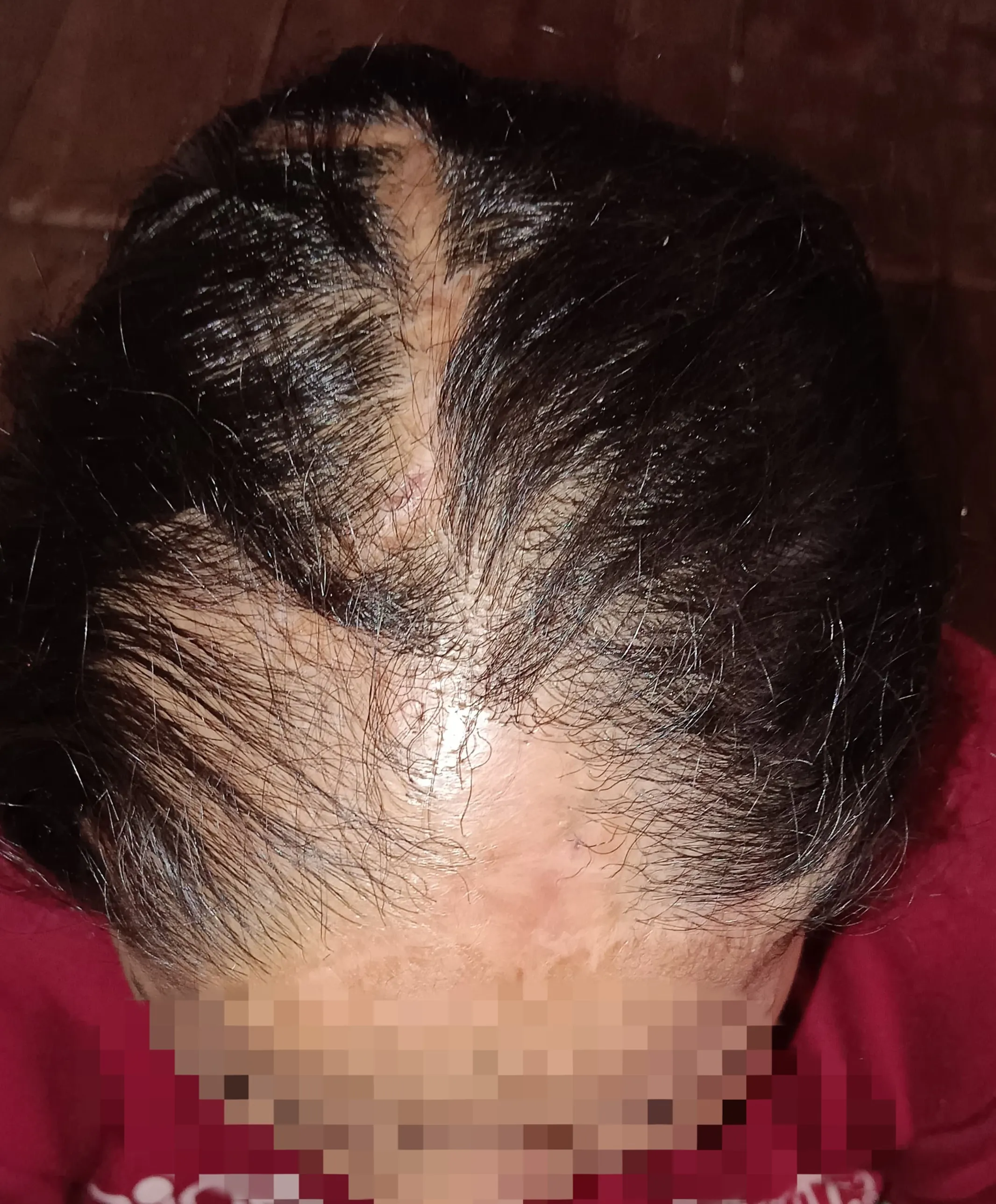 Burn Scar Hair Loss — after