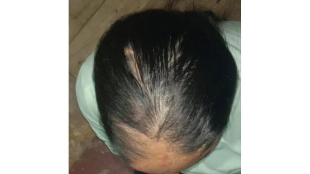 Burn Scar Hair Loss — after