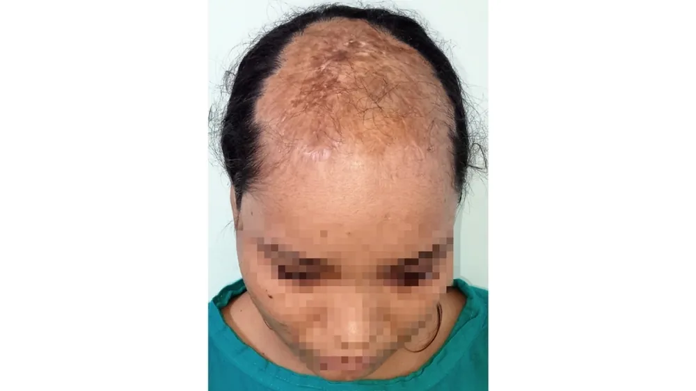 Burn Scar Hair Loss — before