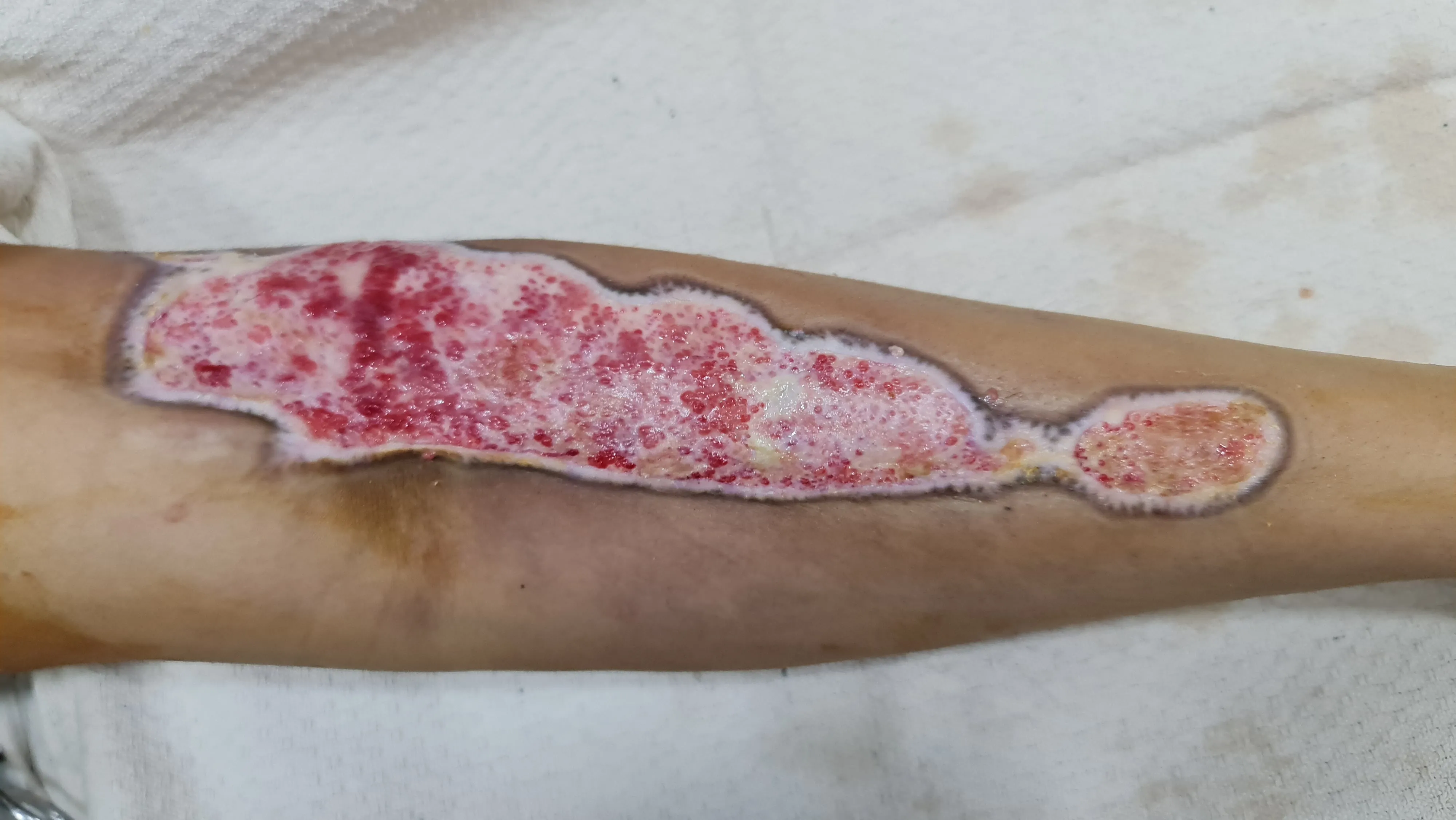 Burn Wounds — before