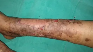Burn Wounds — after