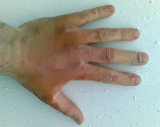 Chemical Burn — after